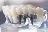 Dental implants - 3Dental Dublin, Limerick & Galway